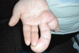 世界上最大的手 巨指病人刘华左手拇指测量长达26厘米